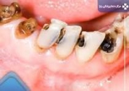 مدیریت پسماند در مطب های دندانپزشکی: یک مطالعه مروری نظام مند